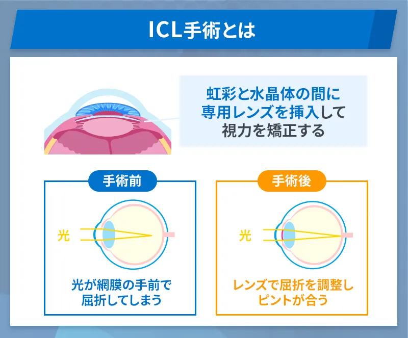 ICLとは