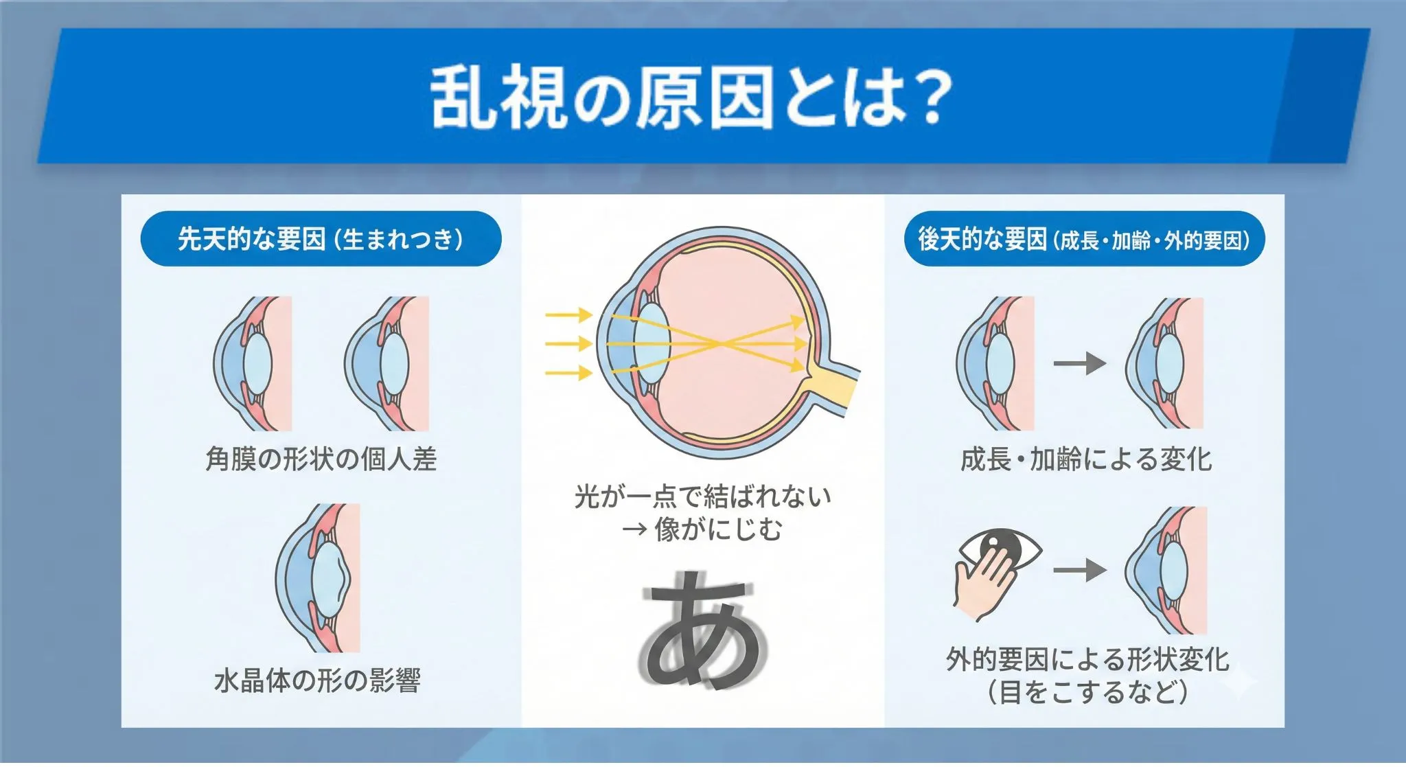 乱視の原因とは？乱視になるメカニズムを解説