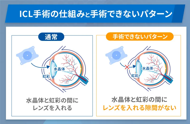 ICL手術は水晶体と虹彩の間にレンズを入れる隙間がないと受けられない