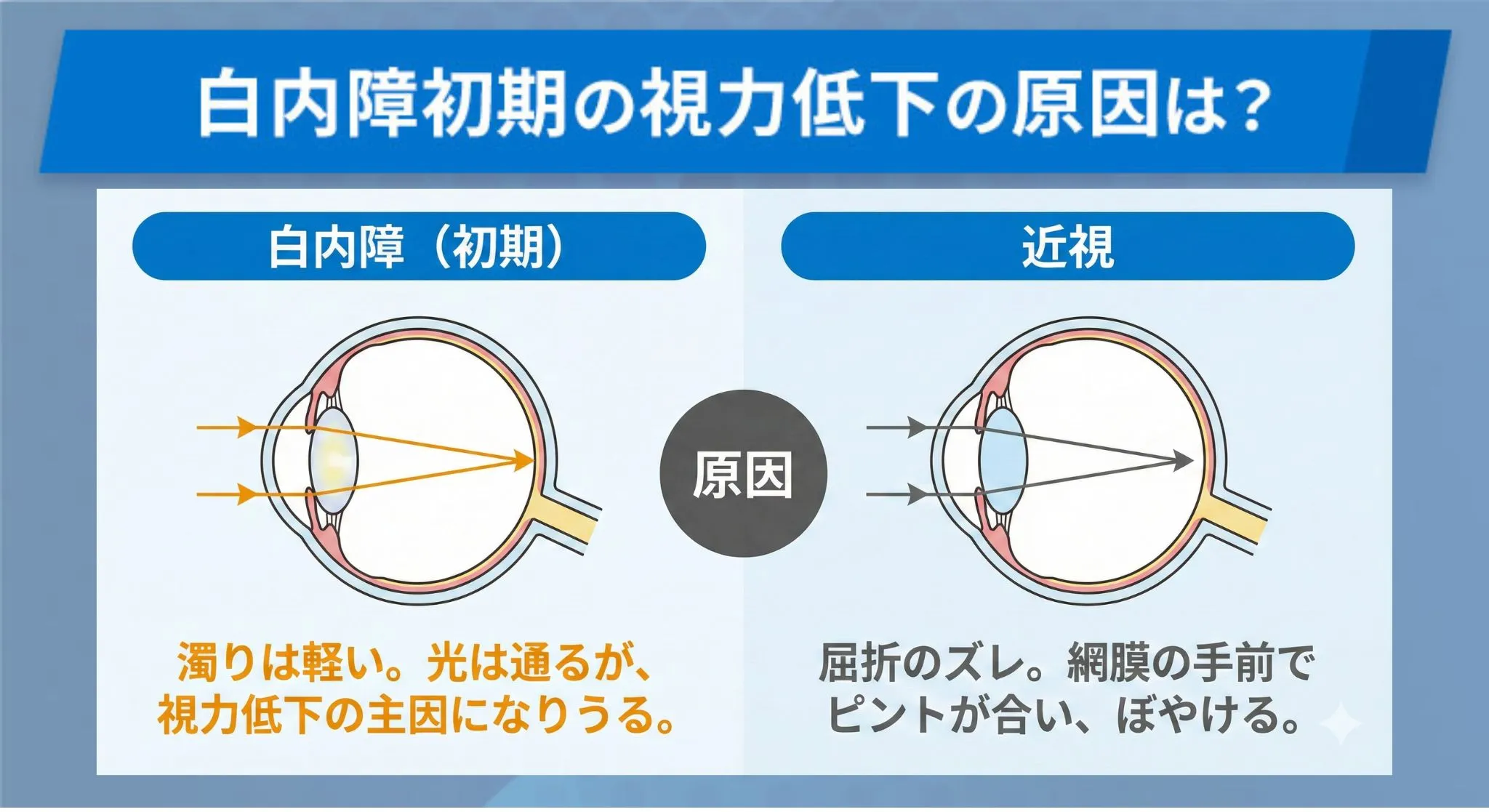 白内障の症状が初期段階で視力低下の原因が近視の場合
