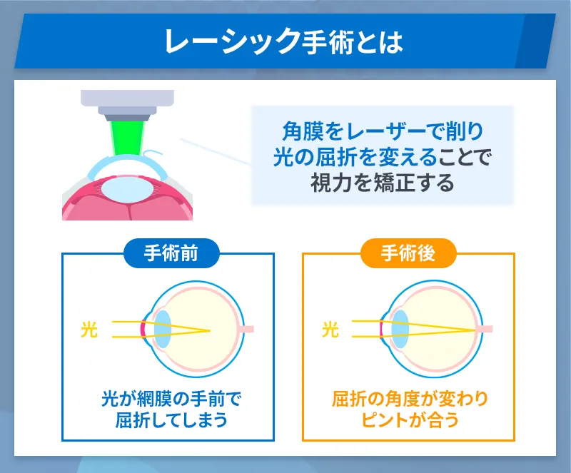 レーシックとは
