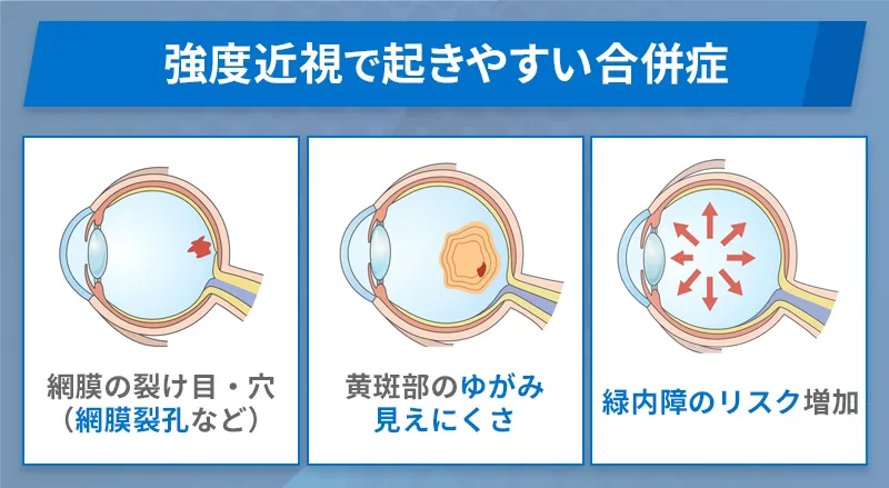 強度近視による失明リスクと合併症