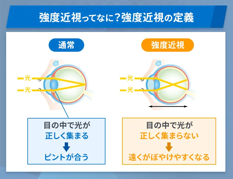 強度近視の定義