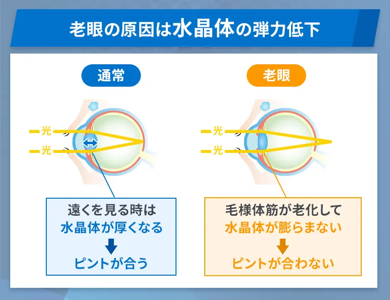 老眼の原因は水晶体の弾力が低下すること